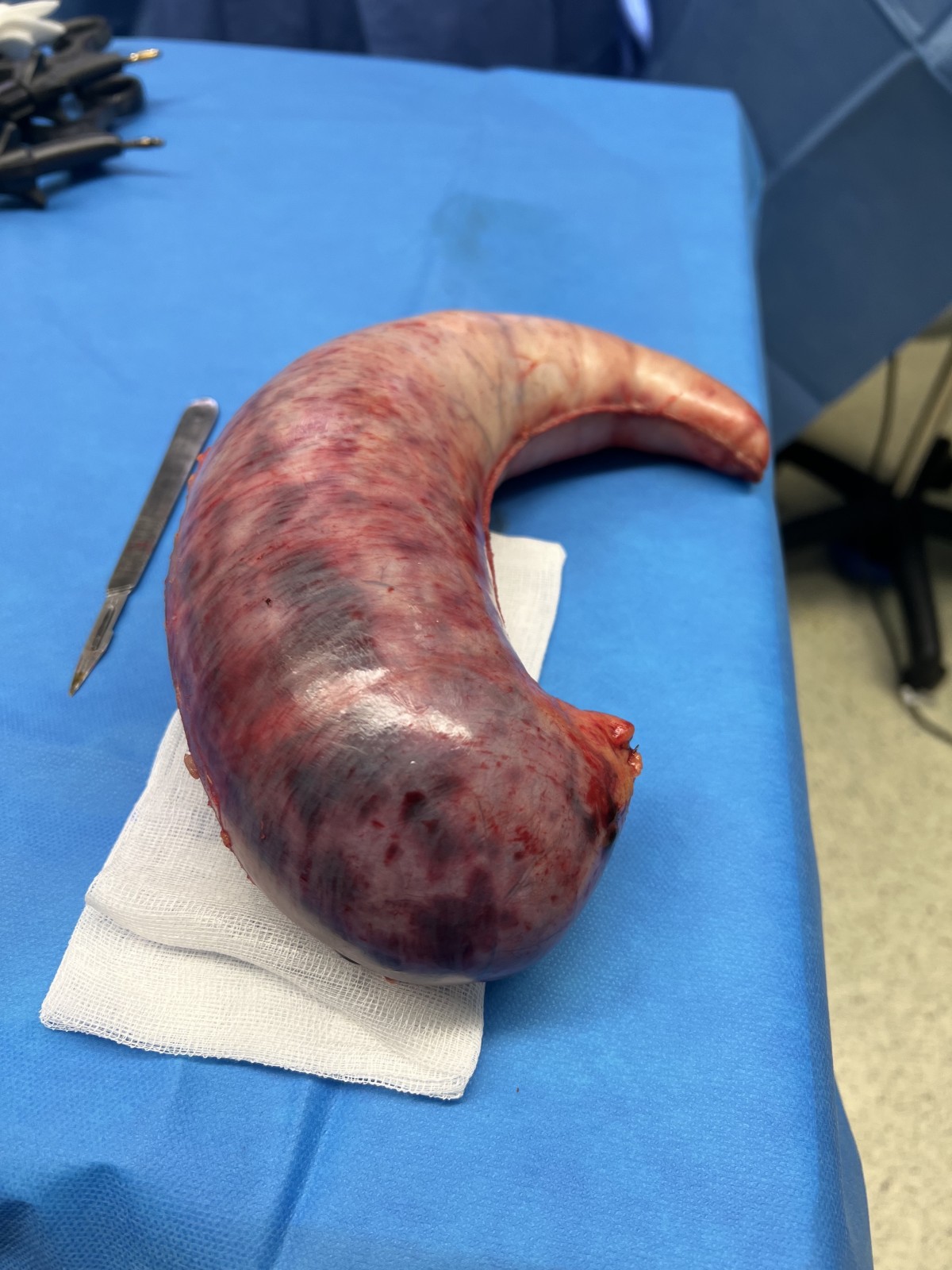 Les super-obèses avec IMC≥60 kgs/m2: Recommandations du groupe MUST à Paris.