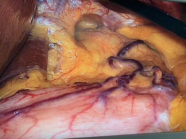 Hernie hiatale et reflux après sleeve