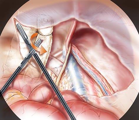 Chirurgie hernie inguinale