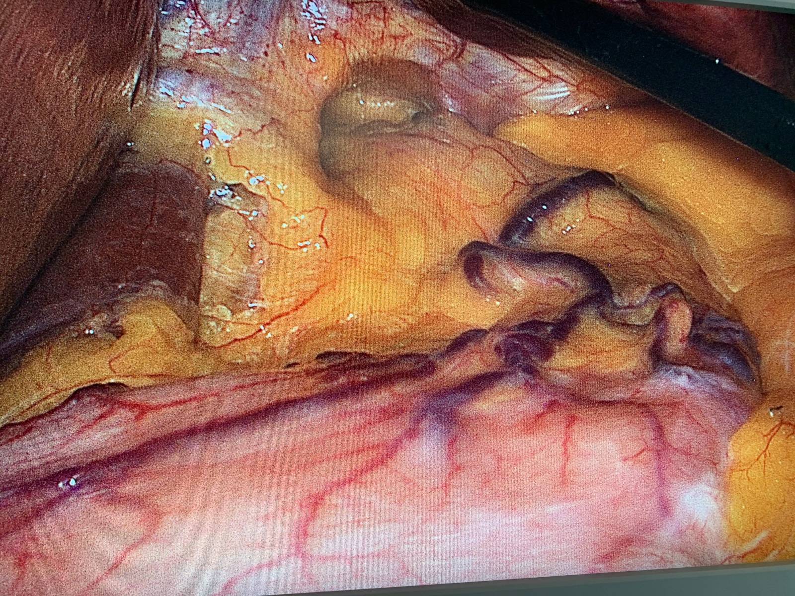 1.	Traitement chirurgical des complications fonctionnelles après sleeve : la conversion en bypass gastrique en Y.