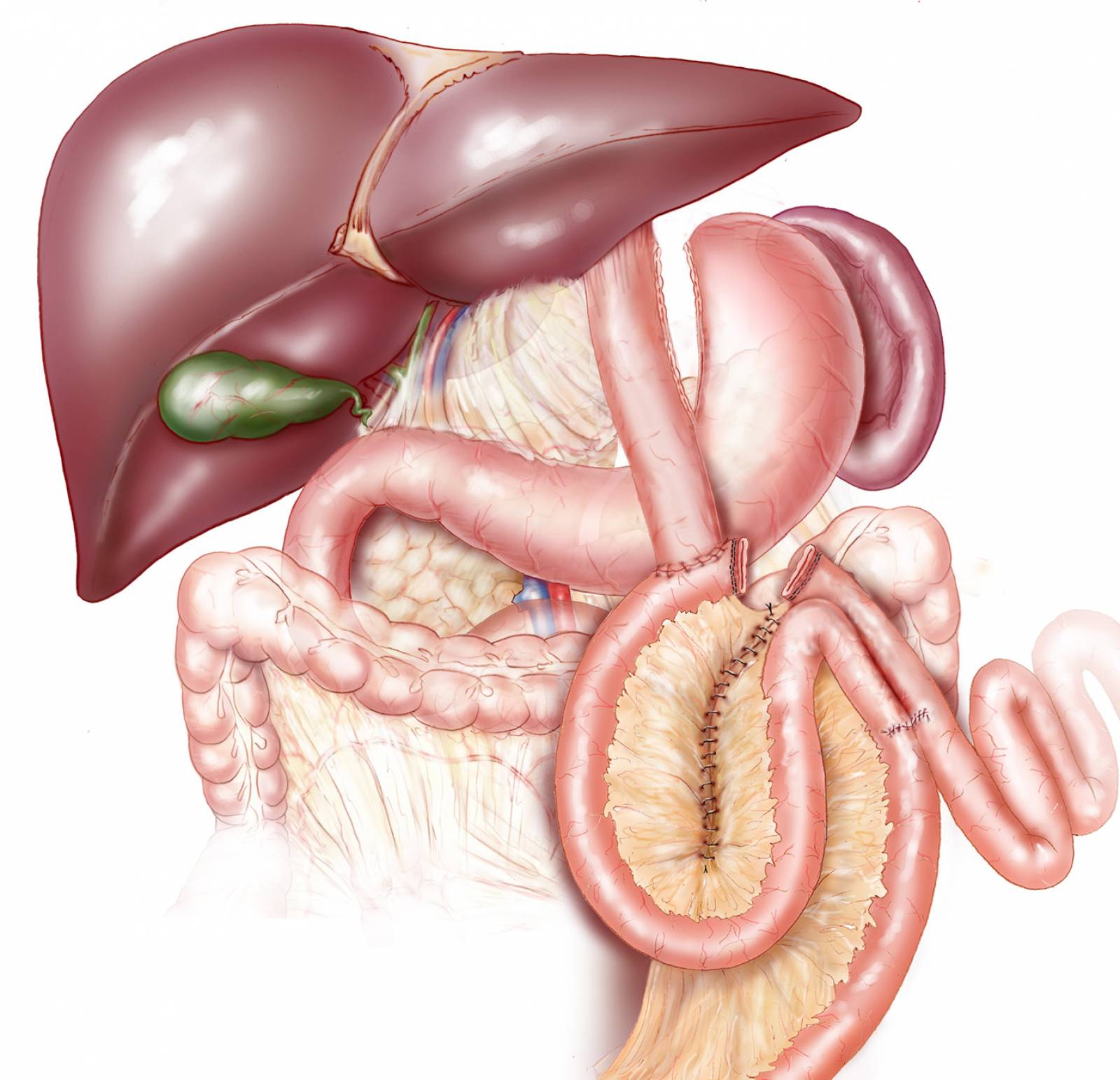 La Société Savante Française de Chirurgie de l'obésité approuve les recommandations de l'IFSO (Aout 2022).