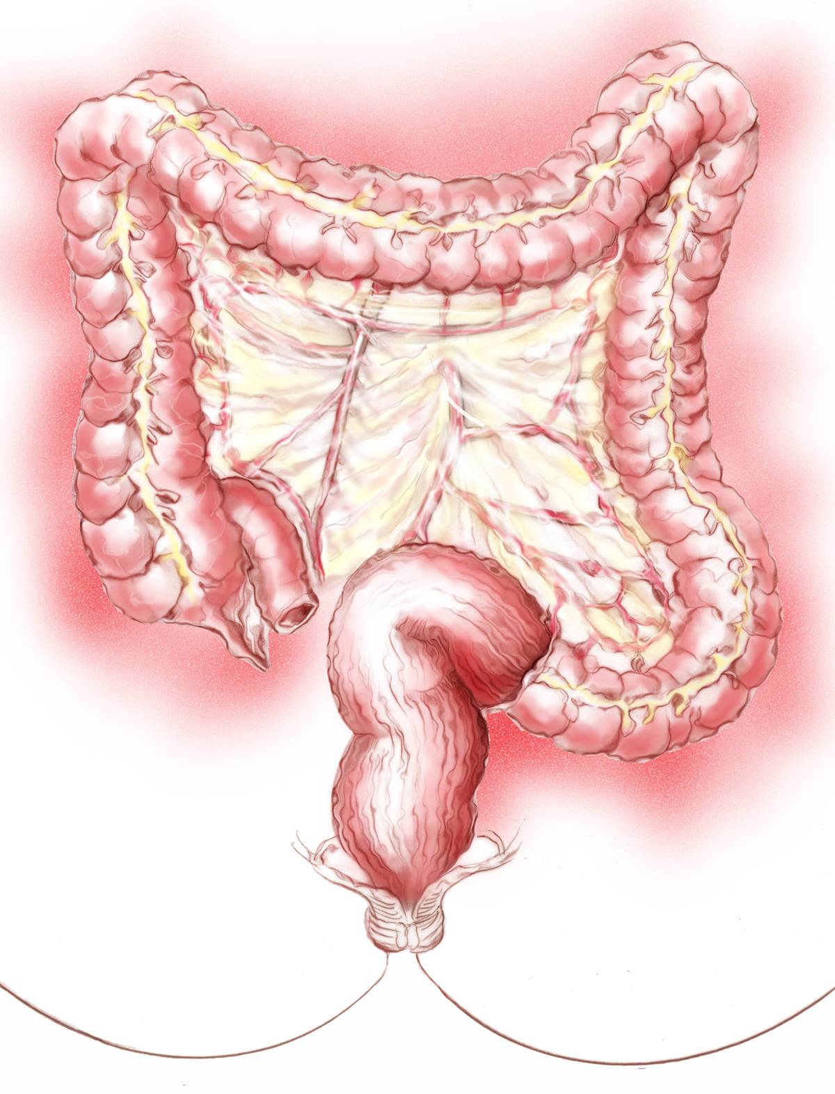prolapsus hémorroidaire