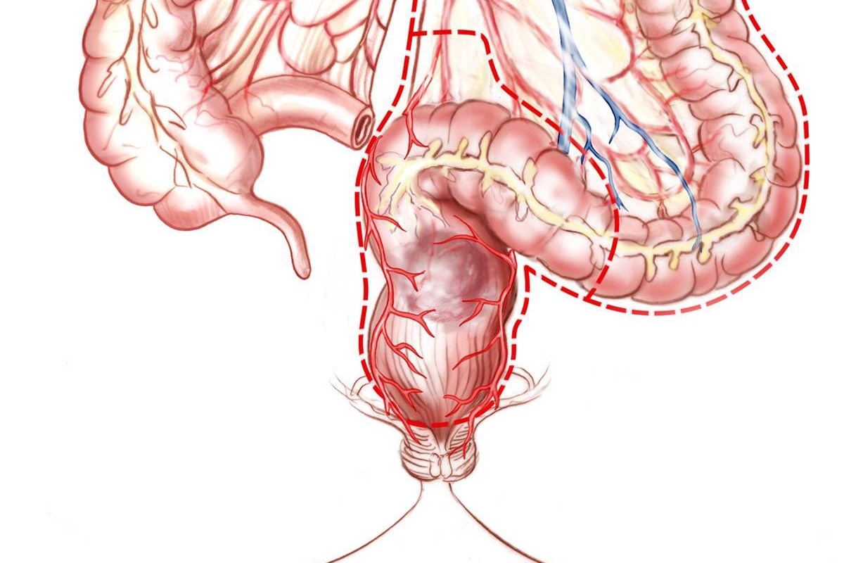 Traitement chirurgical des cancers du moyen et bas rectum par un chirurgien digestif à Paris