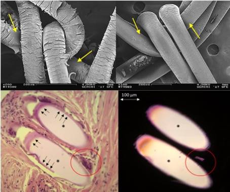 Dégradation de la prothèse