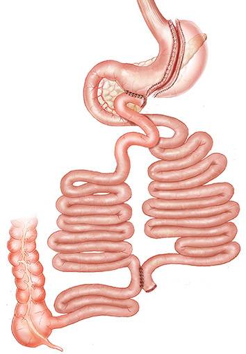 Quelle solution en cas de reprise de poids après sleeve ? Opération de Santoro