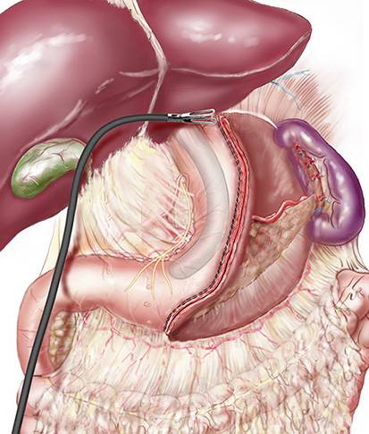 Reflux persistant malgré conversion de sleeve en bypass