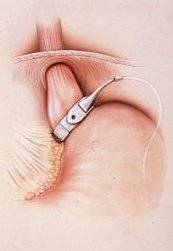 quelle solution en cas de reprise de poids après anneau gastrique ? Le Bypass Gastrique.