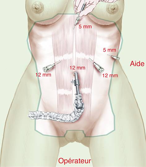 Néo-vagin, chirurgie du transgenre