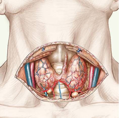 Chirurgie de la thyroïde