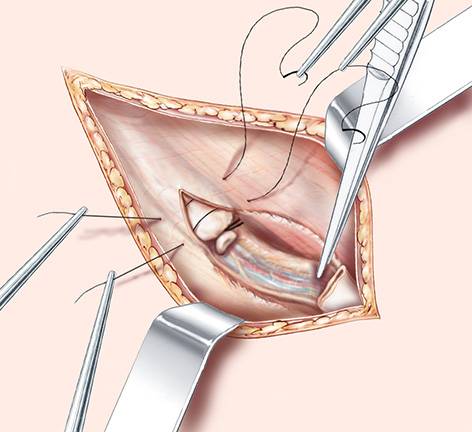 chirurgien expert cure de hernie inguinal sans prothèse