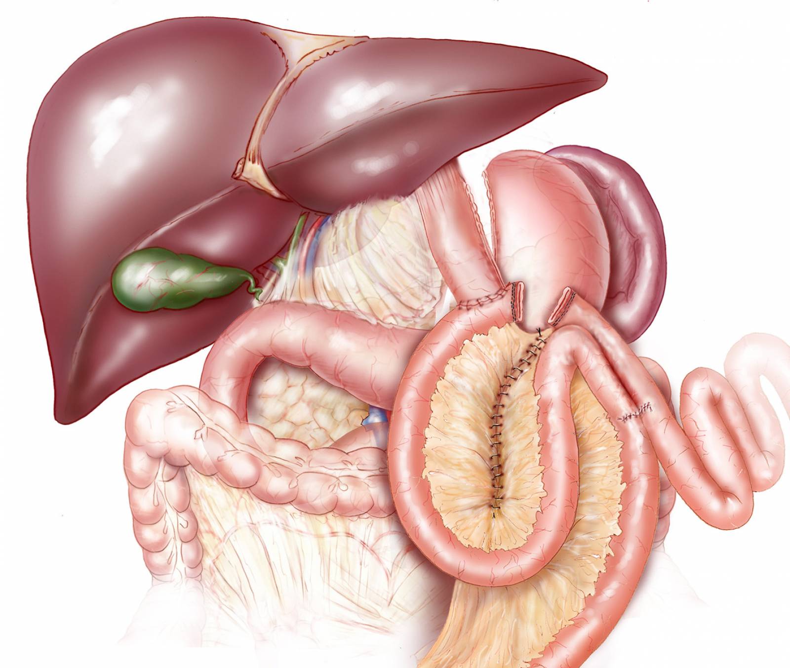 La chirurgie Métabolique: traitement du diabète de type 2  pour les IMC entre 30 et 35 kg/m2 à Paris.