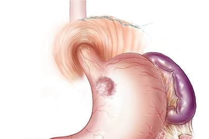 Traitement chirurgical des cancers du cardia par un chirurgien digestif à Paris.