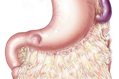 Traitement chirurgical des cancers de l'antre gastrique par un chirurgien digestif à Paris.