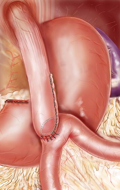 Le mini-bypass (ou Bypass en Oméga) réversible: quand faut-il le réverser ? Réponse du groupe MUST à Paris