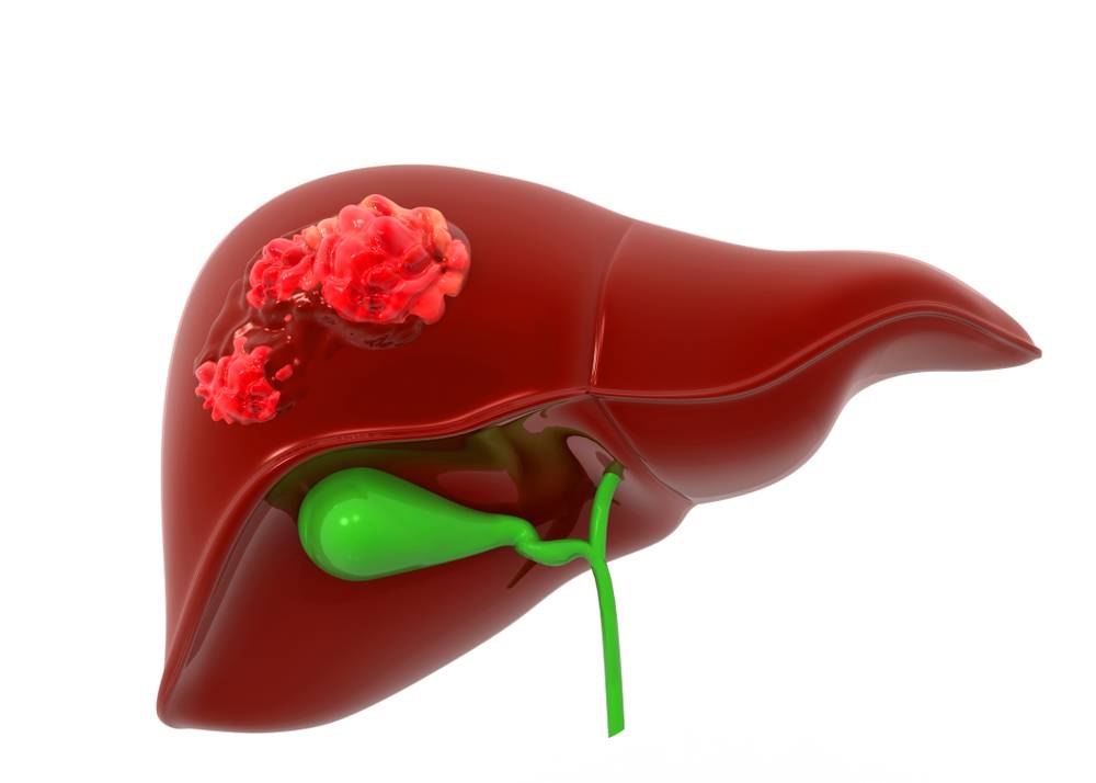 Meilleure opération à Paris pour la résection des métastases hépatiques : la résection atypique sous coelioscopie