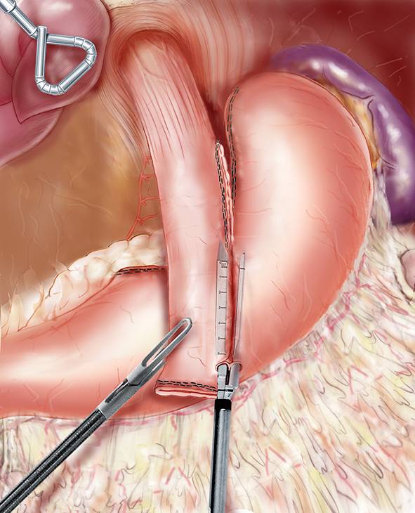 Sleeve ou bypass pour obésité sévère ou morbide 