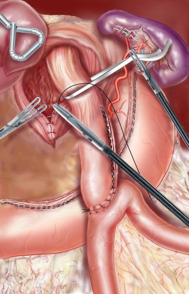 cas complexes en chirurgie bariatrique