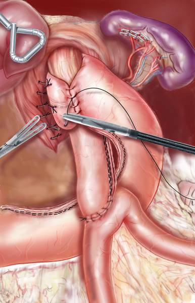 Recommandations internationales IFSO sur la Chirurgie bariatrique: avis des Chirurgien digestifs du groupe MUST à Paris.