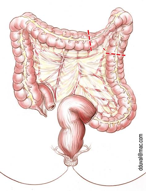 Néo-vagin par sigmoido-plastie - chirurgie du Transgenre