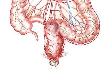 Meilleure opération à Paris pour les cancers du rectum : la résection colo-rectale sous coelioscopie.
