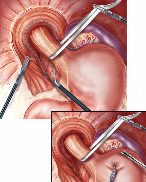 Meilleure technique en coelioscopie pour le traitement du reflux gastrique à Paris