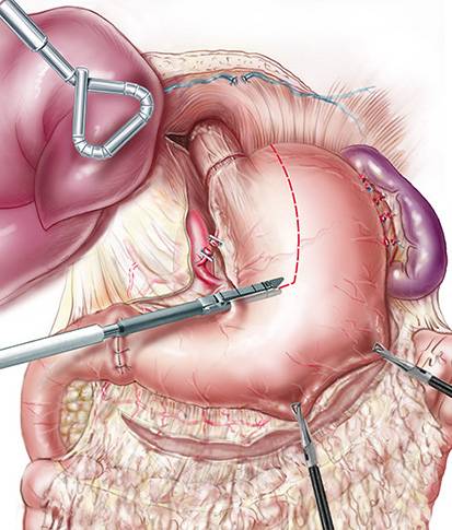 Meilleure technique chirurgicale pour le traitement des cancers de l’œsophage à Paris