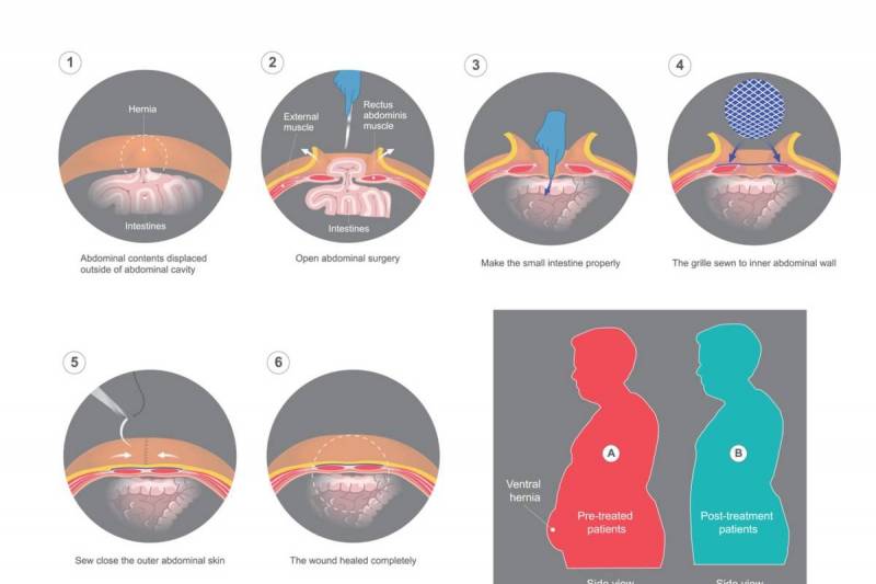 Traitement chirurgical des hernies de la paroi abdominale